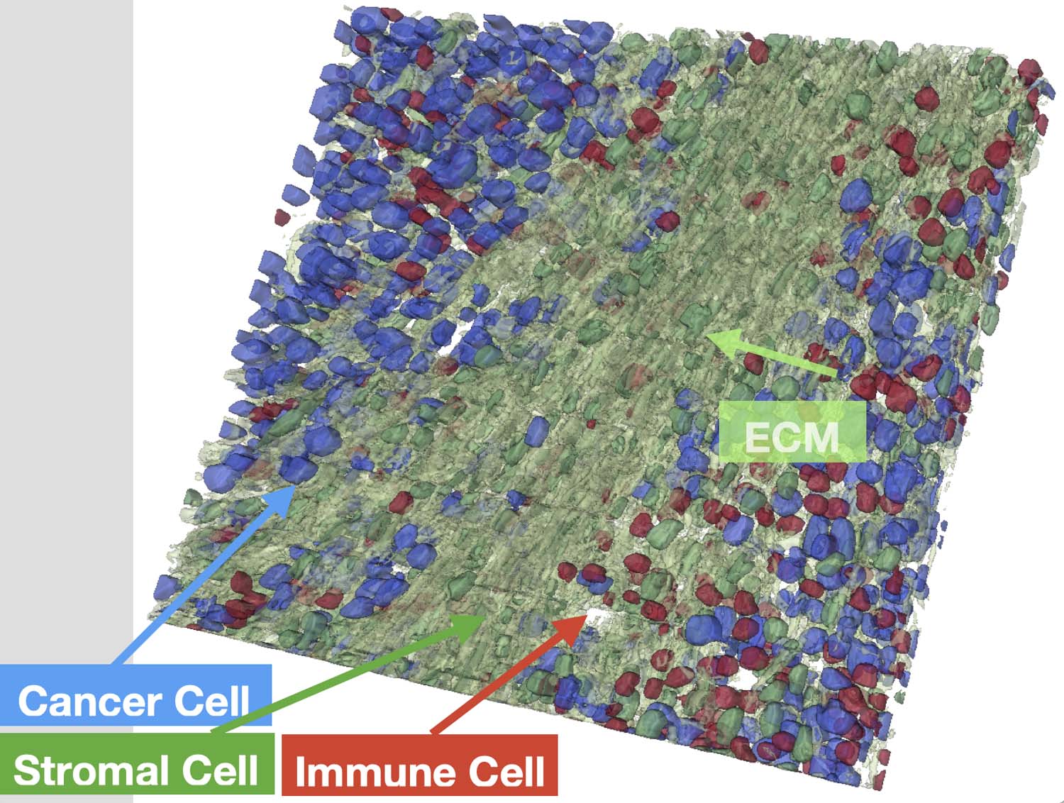 An AI-driven rendering and analysis of a holotomography-based 3D reconstruction of a tumor tissue sample derived from a spatial molecular experimental platform. Cancer cells (blue), stromal cells (green), and immune cells (red) are highlighted, while the extracellular matrix (ECM) appears in translucent green with a green arrow indicating its orientation. By integrating spatial molecular measurements, this approach offers single-cell and subcellular functional characterization, providing key insights into cellular interactions and communication in a three-dimensional context to deepen our understanding of the tissue’s architecture and composition.