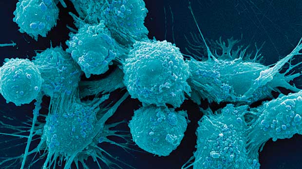 Prostate cancer cells