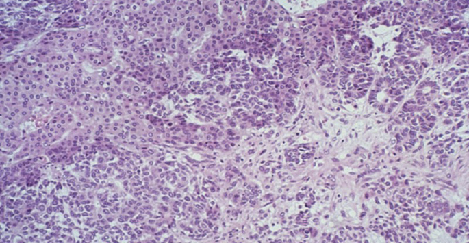 N0006939 Hepatoblastoma; liver cancer, photomicrograph